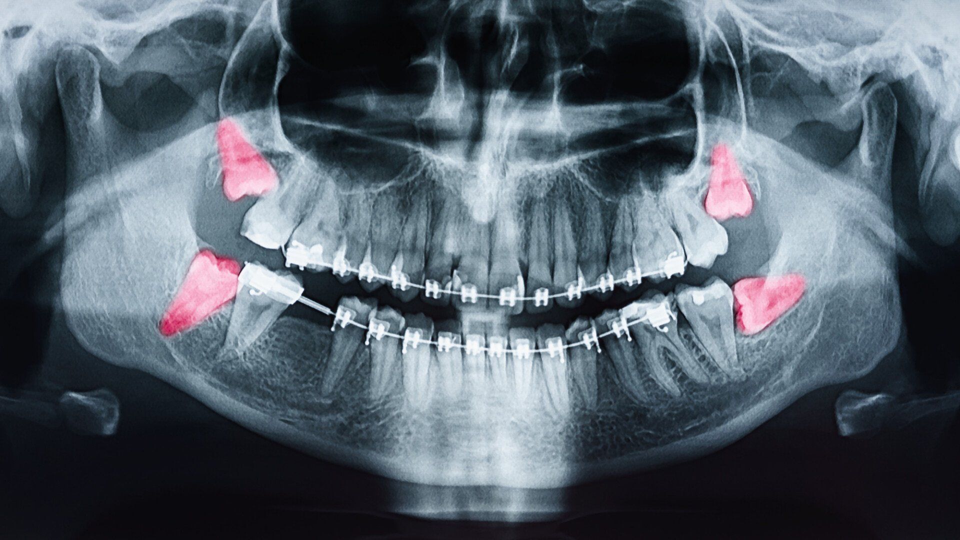 Educational X-ray illustration highlighting wisdom teeth at the back of the jaw